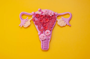 endometriosis